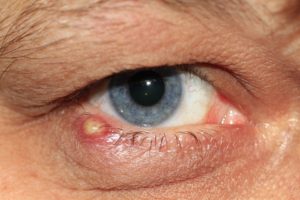 očná infekcia-účinky